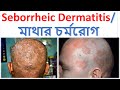 মাথায় চর্মরোগ বা ফাংগাল ইনফেকশন । Skin Disease or Fungal Infection । Dr A Mannan