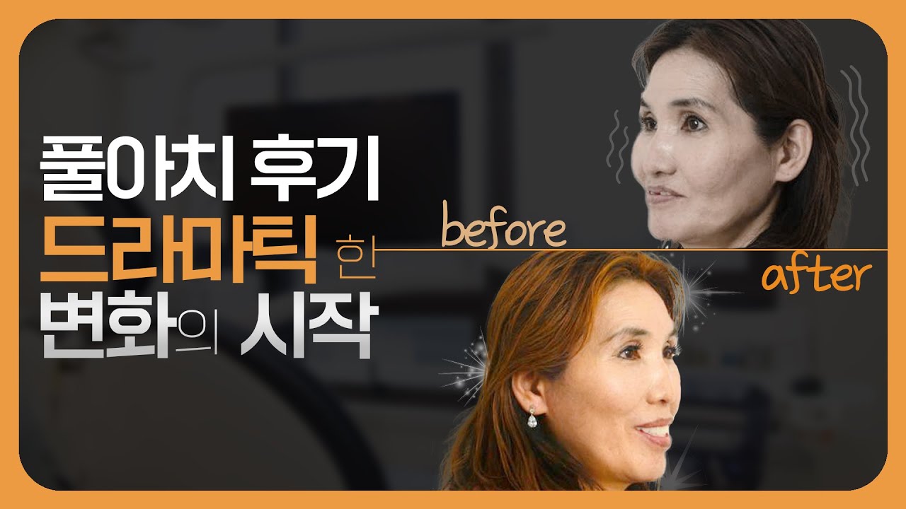 틀니로 미소를 잃고, 풀아치로 미소를 찾은😊 풀아치 후기🦷