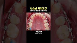 청소년 치아, 26개월 동안 변화 과정