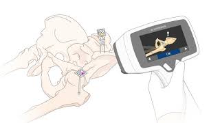 SmartAssisted Surgery - Miniaturized Hip Navigation