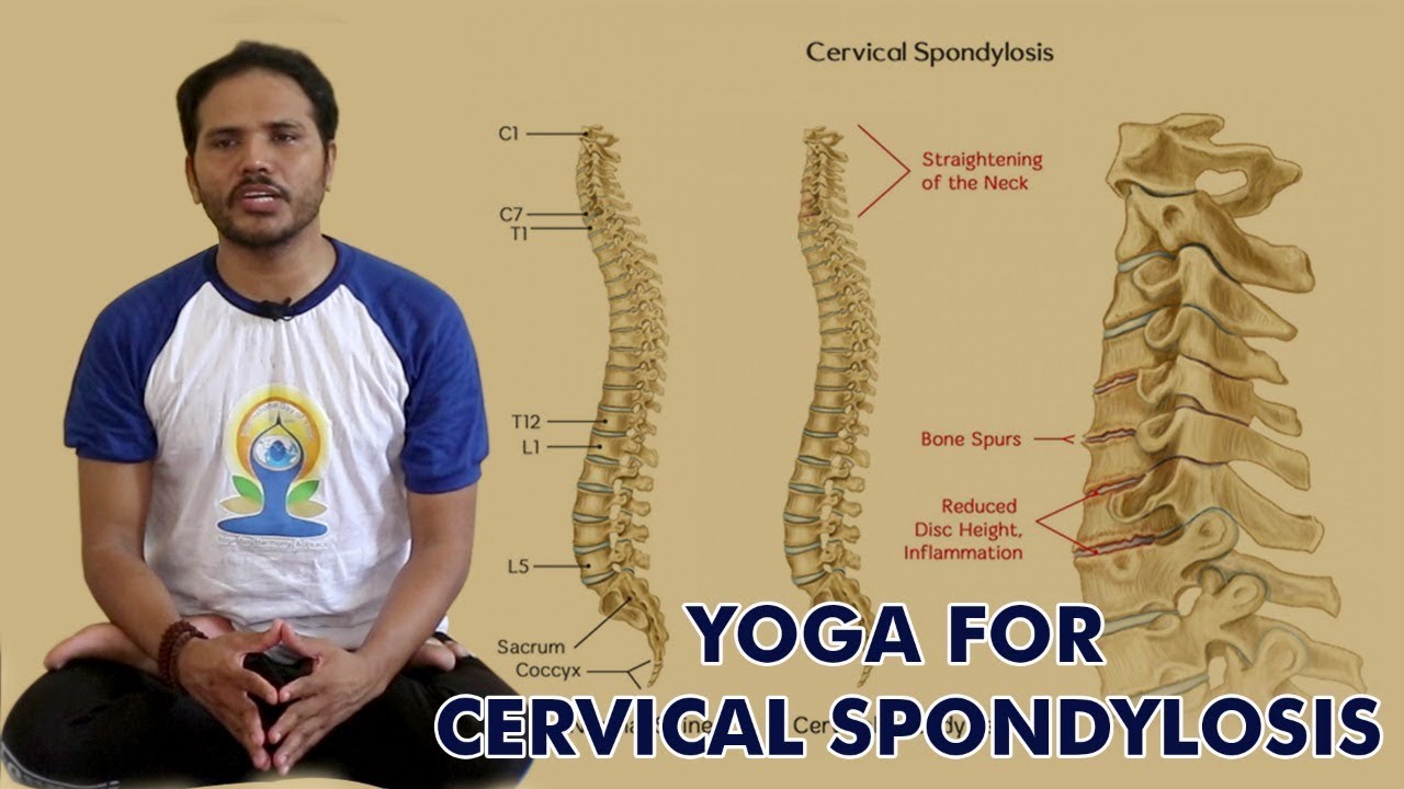 Sure Cure For Cervical Pain | Neck Pain | Stiff Neck | Spondylitis |Spondylosis | Frozen