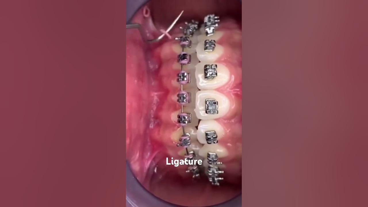How ligature will remove from bracesOrthodontic DentistryLets clear ur Smile🦷😀 YouTube