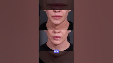 Life-changing Results after Facelift | Dr. Paul Nassif