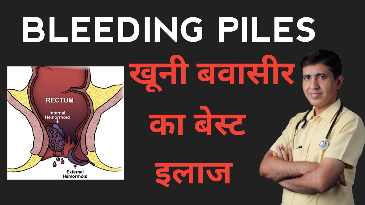 Bleeding Piles Symptoms And Treatment खुनी बवासीर का इलाज खुनी