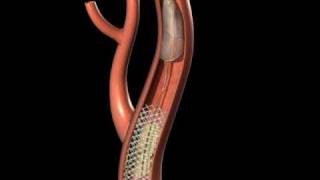 Protected Carotid Stenting