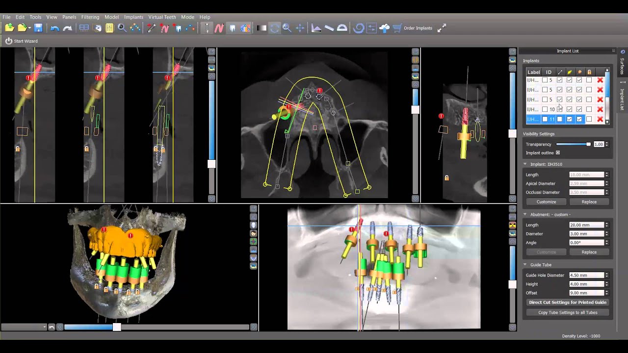 Using a Patient's Denture to Create a Surgical Guide