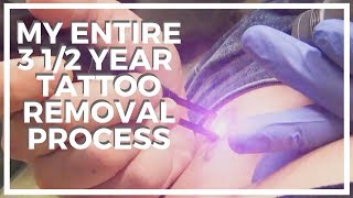 My Tattoo Removal Experience ♥ 3 1/2 Year Process With Serenity Medspa, and Laseraway @Katrinaosity