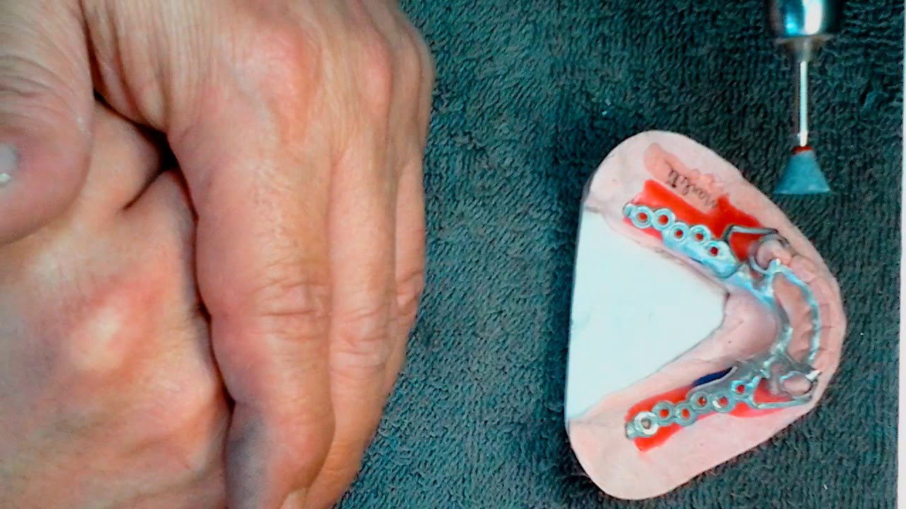 Prótese Parcial Removível - Usinagem e Polimento - Parte1