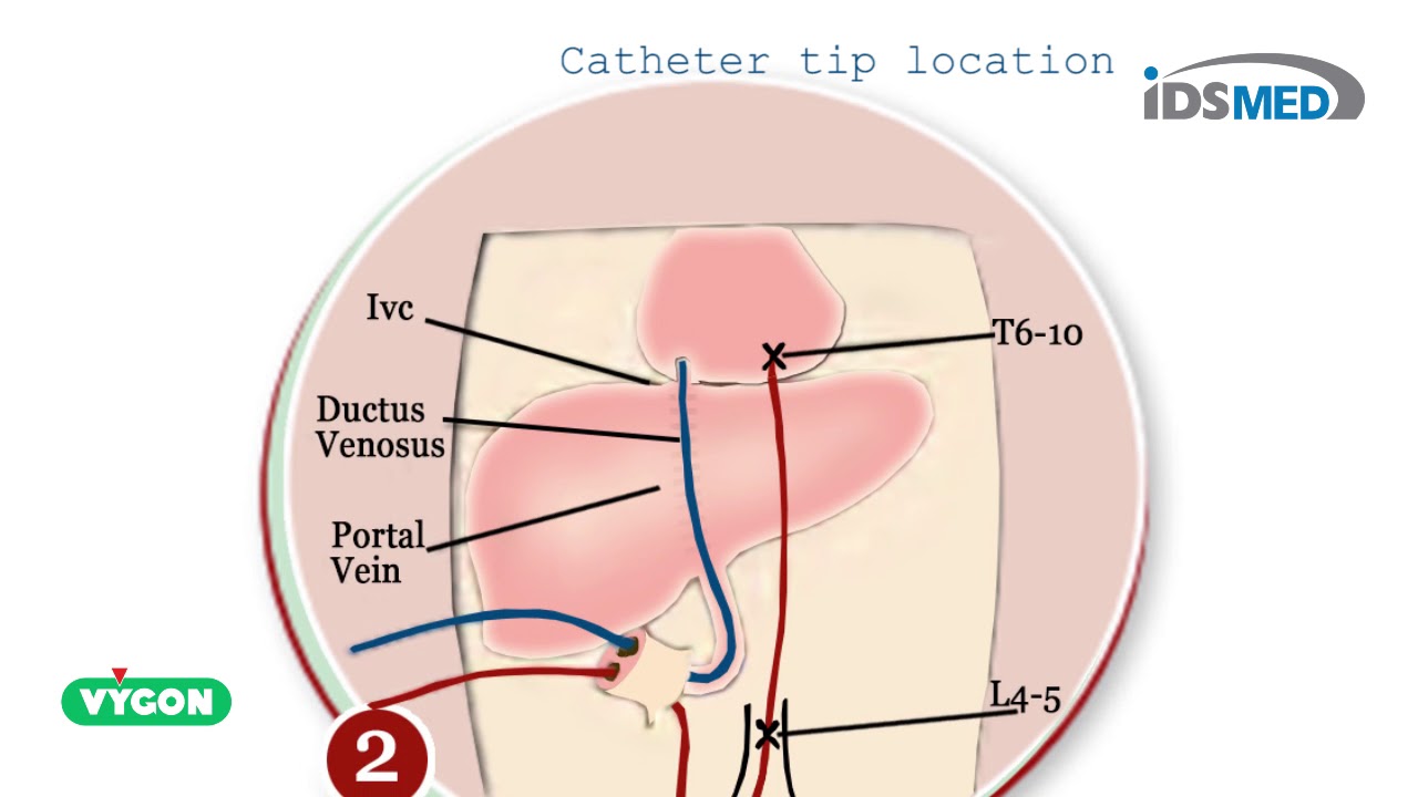 Vygon Umbilical Catheters (PUR) YouTube