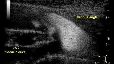 Ultrasound Imaging of the Thoracic Duct