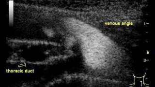 Ultrasound Imaging of the Thoracic Duct