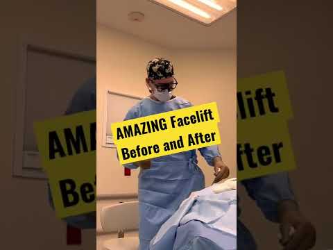 INCREDIBLE Facelift before