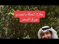 علاج الحكه بالجسم الدكتور خالد الطيب 