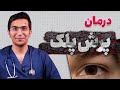 علت پرش پلک چشم چیست معرفی روش درمان آن