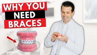 Why BRACES are better than INVISALIGN | Orthodontist | Dr. Nate