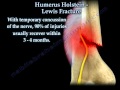 Humerus Holstein Lewis Fracture - Everything You Need To Know - Dr. Nabil Ebraheim