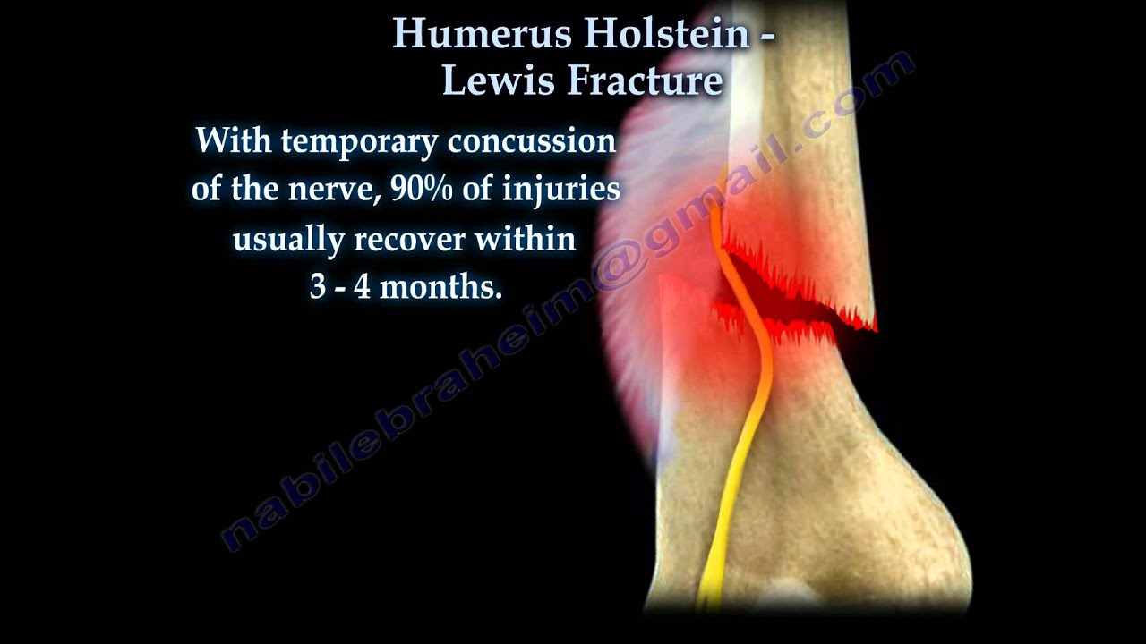 Humerus Holstein Lewis Fracture - Everything You Need To Know - Dr. Nabil Ebraheim