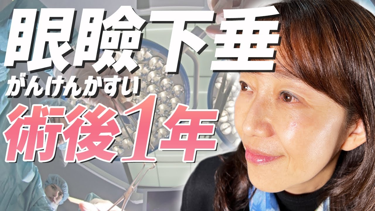 【眼瞼下垂】手術から一年経ち経過をご報告。今の状態は？！質問にもお答え！