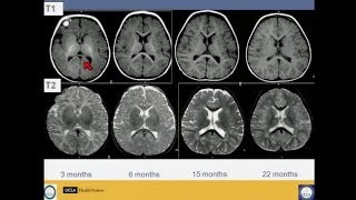Neuroimaging of Pediatric Disease