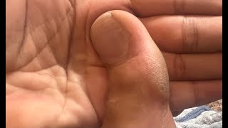 Ingrown Nail with Meta Seven Update