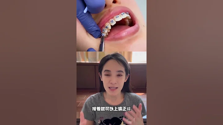 挑戰五分鐘內上完全口矯正器。矯正時牙齒一長一短怎麼辦？＃第一次上矯正器＃Shorts - 天天要聞