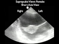 FAST Exam - Suprapubic Views - SonoSite, Inc.