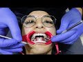 I GOT BRACES + vlogged the whole process !