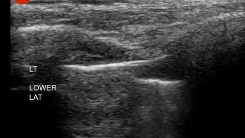 Pneumothorax - ultrasound -  Lung Point