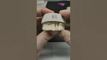 металлокерамическая коронка цвет a2  22 зуб #зубнойтехник #dental #мк #зубы #shorts