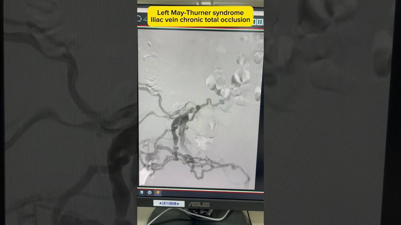 Left May-Thurner syndrome with iliac vein long CTO (chronic total occlusion)