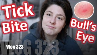 Ch.323: My New Tick Bite & Bull’s Eye Rash + Treatment I’ve Undergone Since The End Of May