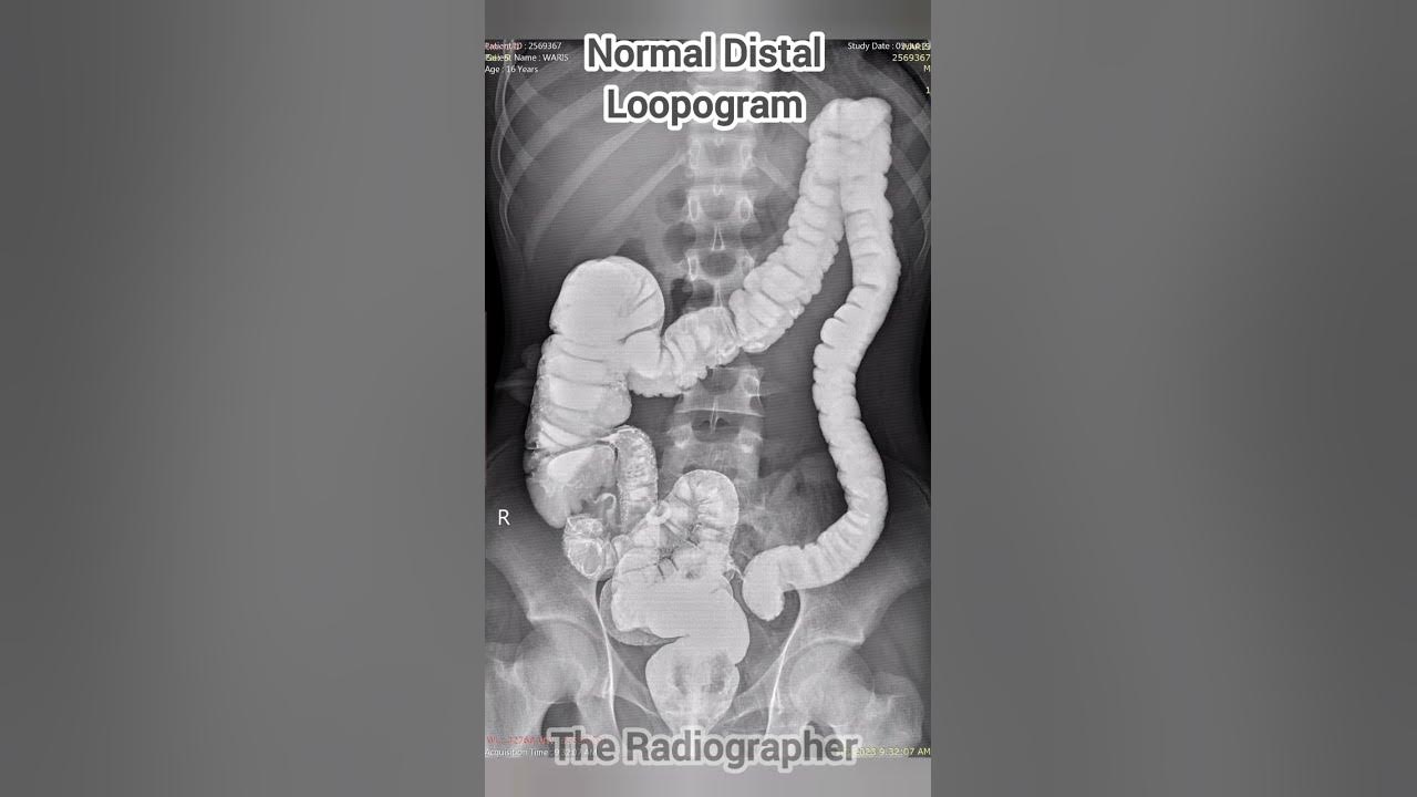 Distal loopogram xray procedure xrayprocedures distalloopogram 