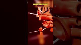 Heart Transplant Explained: Procedure, Recovery