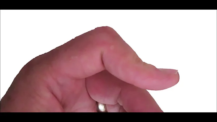 OT Rex - Avulsion Injuries - Mallet Finger, Bouton...