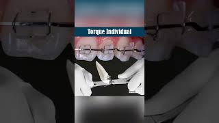 TORQUE INDIVIDUAL - ORTHODONTIC TIPS #Shorts