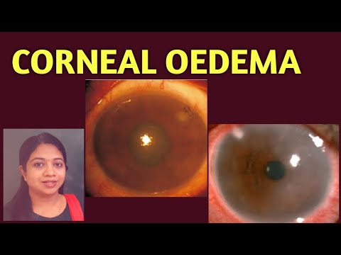 Corneal Oedema|| Epithelial Oedema|| Stromal| Striate keratopathy|Signs| Treatment of Corneal oedema