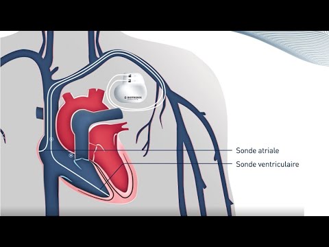 Vidéo: «Moteur» Perpétuel: L'énergie Du Cœur Peut être Utilisée Pour Recharger Les Stimulateurs Cardiaques - Vue Alternative