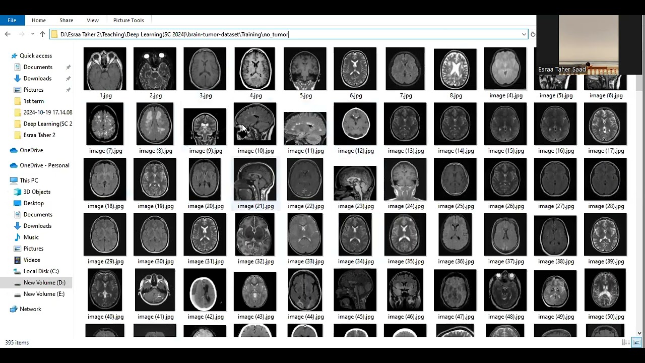 Brain Tumor Classification using CNN شرح