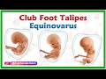 Club foot  talipes equinovarus  causes symptoms diagnosis and treatment