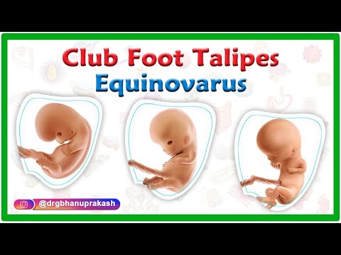 Video: Waarom komt talipes equinovarus voor?