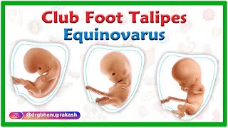 Club foot / Talipes equinovarus : Causes, Symptoms, Diagnosis and Treatment