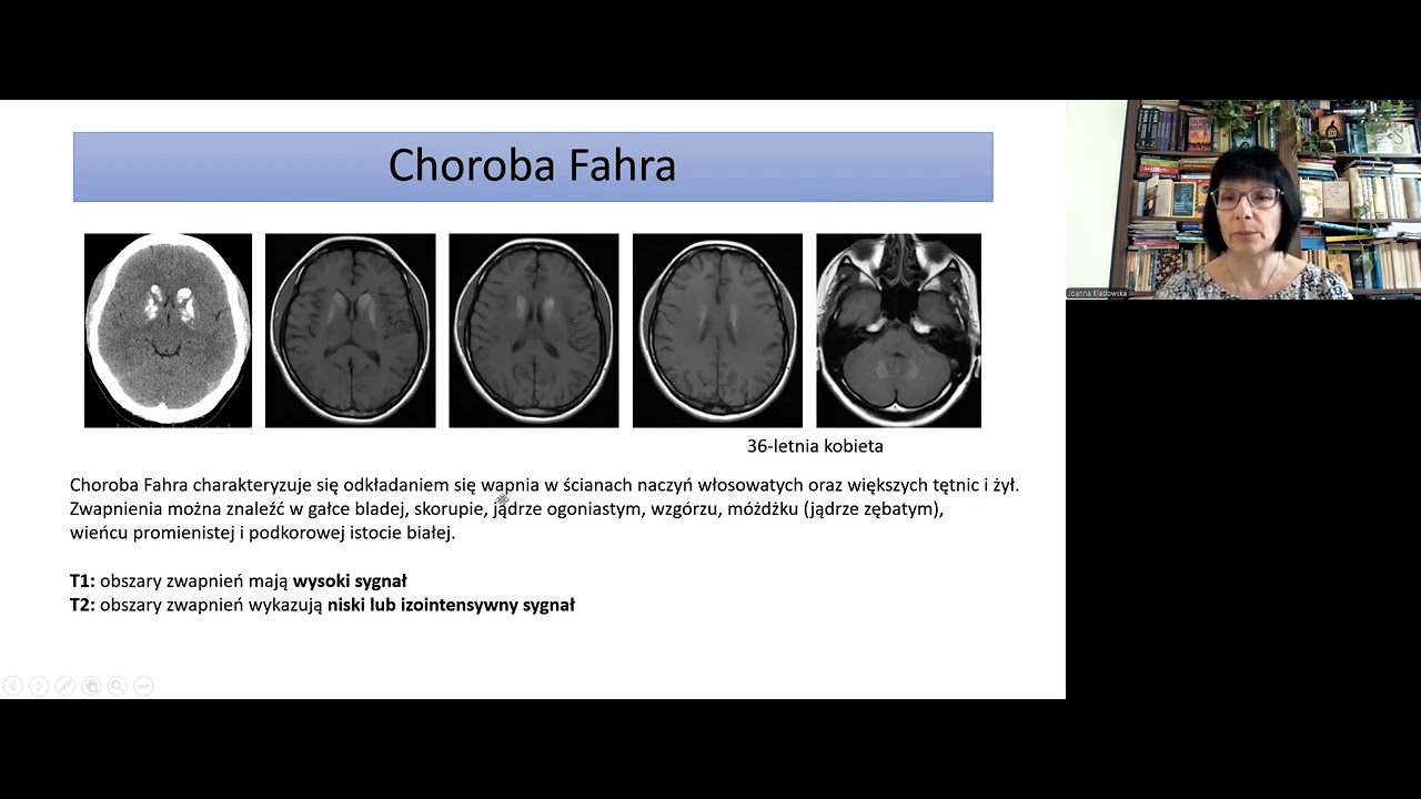 J. Bladowska - Schorzenia jąder podstawy.