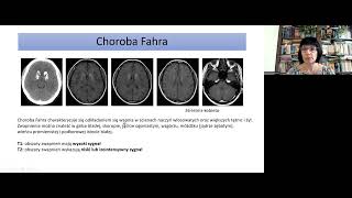 J. Bladowska - Diseases of the basal ganglia. J. Bladowska - Diseases of the basal ganglia.