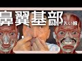 【 鼻翼基部型ほうれい線 】鼻の付け根陥没無くそう!