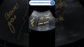 Importance of Adequate Compression While Doing Bowel Ultrasound #ultrasonography #appendicitis