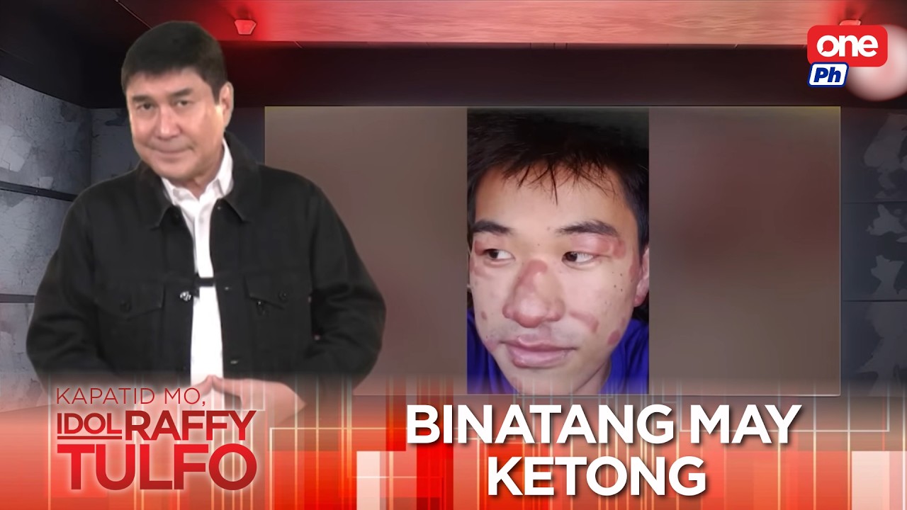 Paano ginagamot ang ketong o leprosy? | Kapatid Mo, Idol Raffy Tulfo
