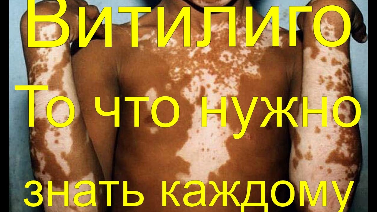Витилиго - Что нужно знать каждому про эту болезнь - YouTube