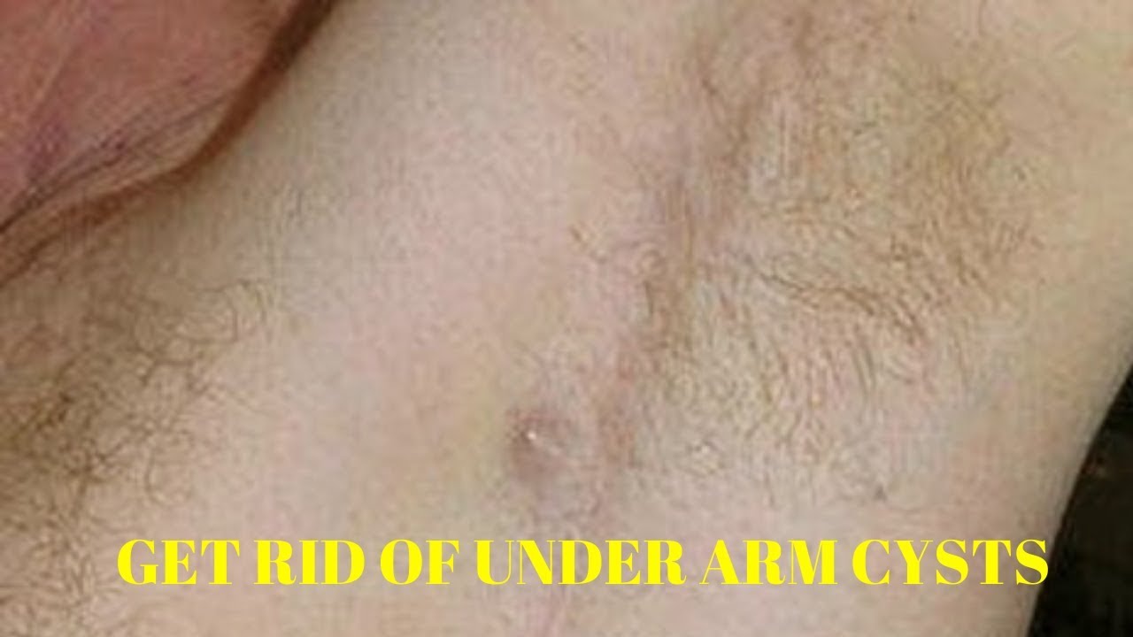 how to get rid of cysts under armpit - YouTube