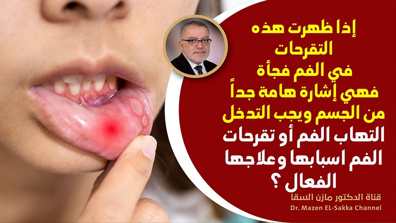 إذا ظهرت تقرحات الفم واللثة فهي علامة ضرورية لهذا الخلل في الجسم ! علاج تقرحات الفم واللثة طبيعيا ؟