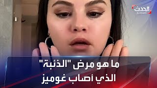 اكتشفه الجمهور.. ما هو مرض النجمة الأميركية سيلينا غوميز؟